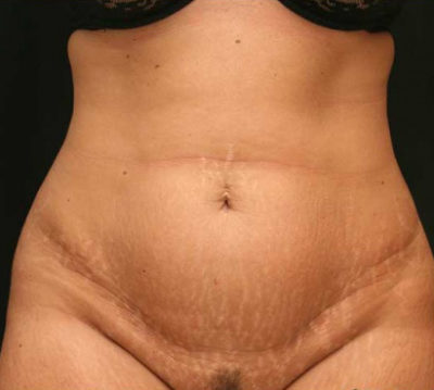 Tummy Tuck