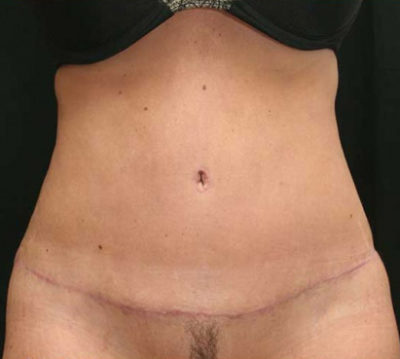 Tummy Tuck
