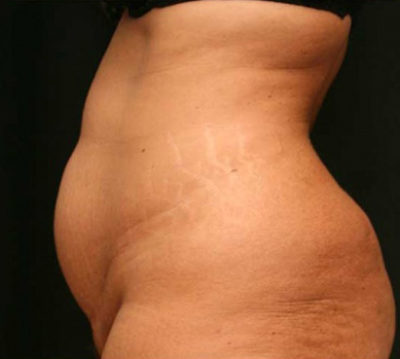Tummy Tuck