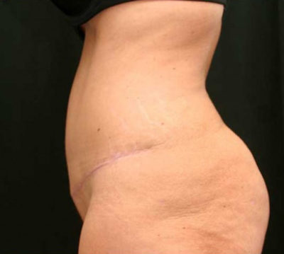 Tummy Tuck