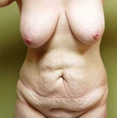 Tummy Tuck