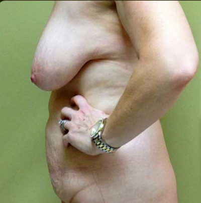 Tummy Tuck
