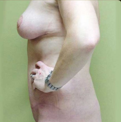 Tummy Tuck