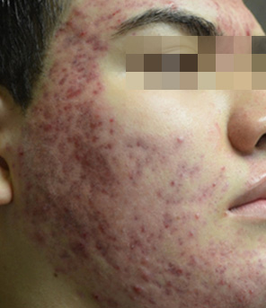 Fractora