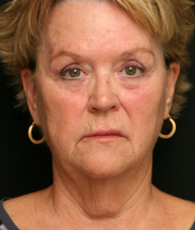 Facial Rejuvenation