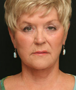 Facial Rejuvenation