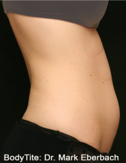 BodyTite
