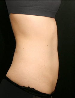 BodyTite