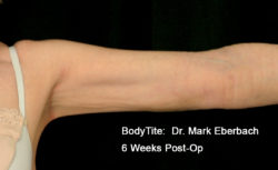 BodyTite