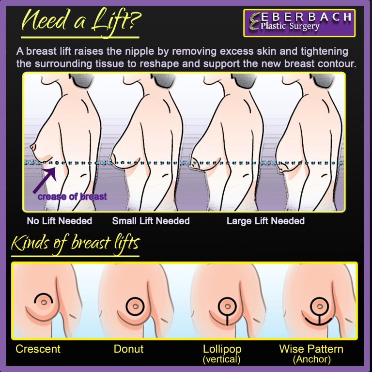 Do I Need a Breast Lift Infographic