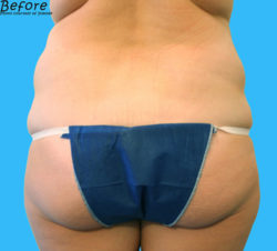 BodyTite