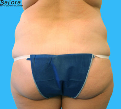BodyTite