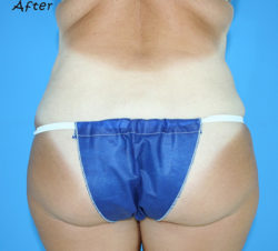 BodyTite