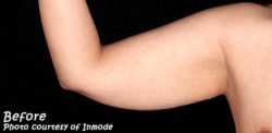 BodyTite
