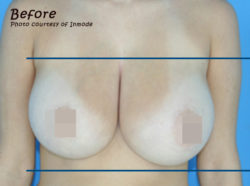 BodyTite