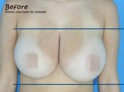 BodyTite