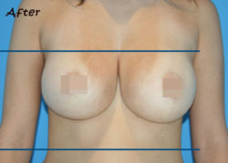 BodyTite