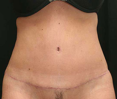 Tummy Tuck