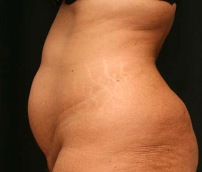 Tummy Tuck