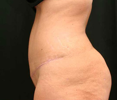 Tummy Tuck