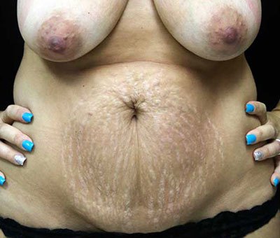 Tummy Tuck