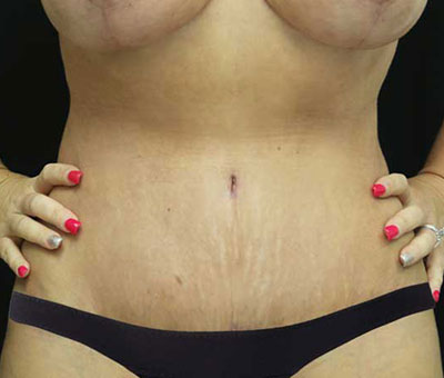 Tummy Tuck