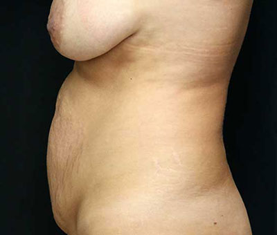 Tummy Tuck