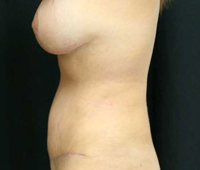 Tummy Tuck