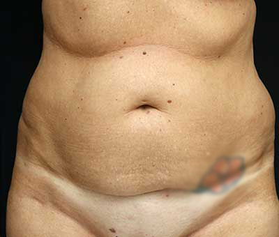 Tummy Tuck