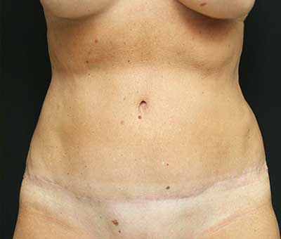 Tummy Tuck