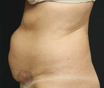 Tummy Tuck