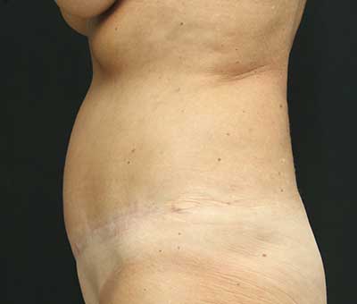 Tummy Tuck