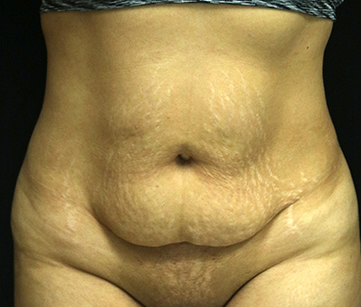 Tummy Tuck