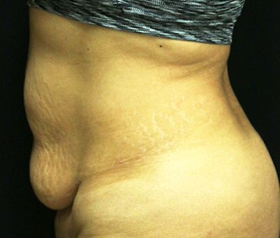 Tummy Tuck
