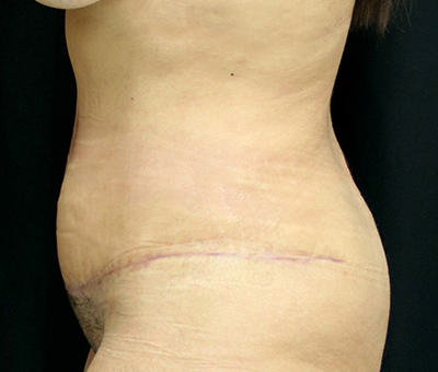 Tummy Tuck