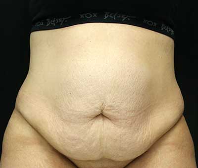 Tummy Tuck