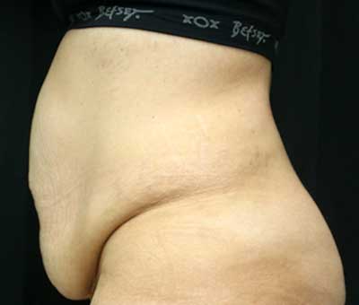 Tummy Tuck