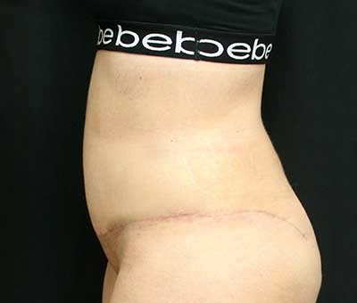 Tummy Tuck