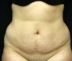Tummy Tuck