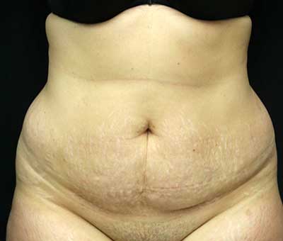 Tummy Tuck