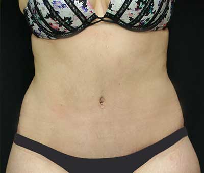 Tummy Tuck