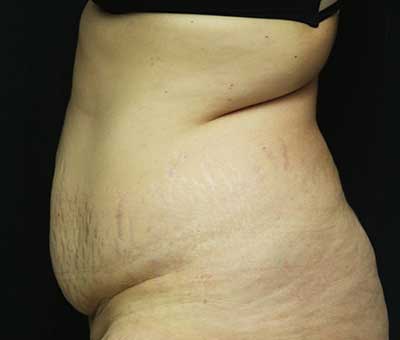 Tummy Tuck