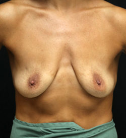 Breast Augmentation - 400cc-499cc