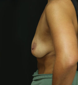 Breast Augmentation - 400cc-499cc