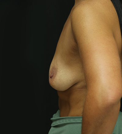 Breast Augmentation - 400cc-499cc
