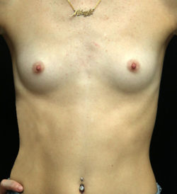 Breast Augmentation - 300cc and under