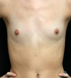 Breast Augmentation - 300cc and under