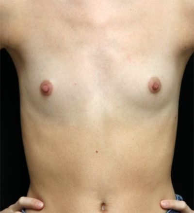 Breast Augmentation - 300cc and under
