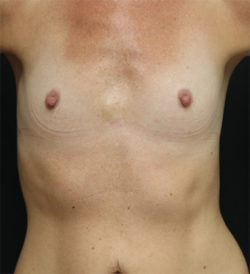 Breast Augmentation - 300cc and under