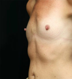 Breast Augmentation - 300cc and under
